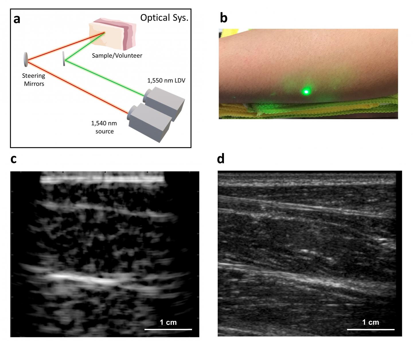 Full Noncontact Laser Ultrasound: First Human Data